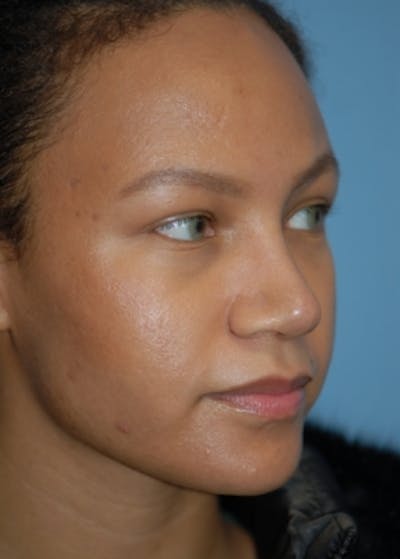 Rhinoplasty Before & After Gallery - Patient 5952152 - Image 4