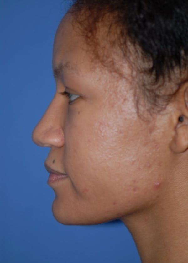 Rhinoplasty Before & After Gallery - Patient 5952152 - Image 5