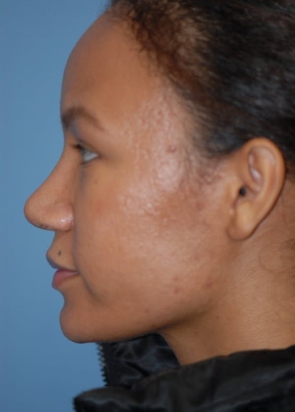 Rhinoplasty Before & After Gallery - Patient 5952152 - Image 6