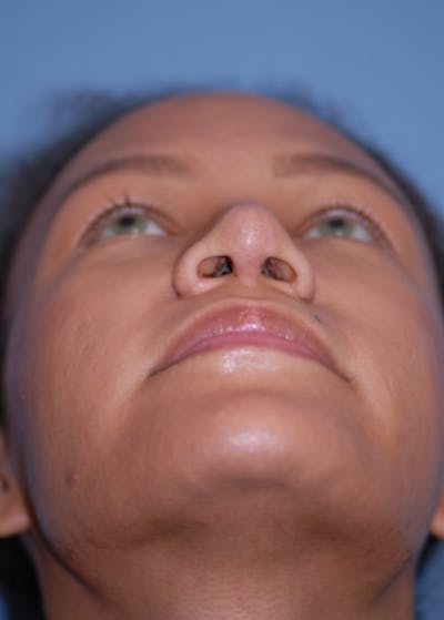 Rhinoplasty Before & After Gallery - Patient 5952152 - Image 8