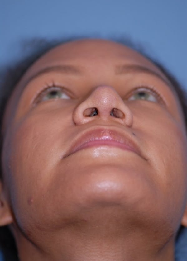 Rhinoplasty Before & After Gallery - Patient 5952152 - Image 8