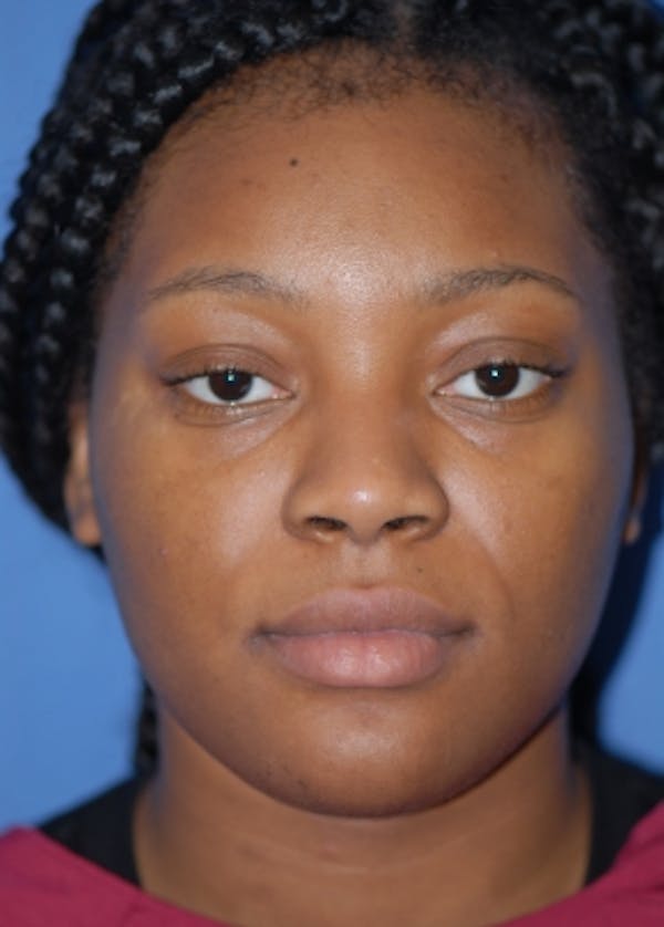 Rhinoplasty Before & After Gallery - Patient 5952174 - Image 1