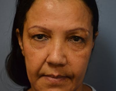 Eyelid Surgery Browlift Before & After Gallery - Patient 5952176 - Image 1