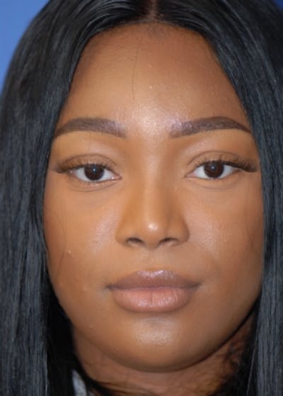 Rhinoplasty Before & After Gallery - Patient 5952174 - Image 2