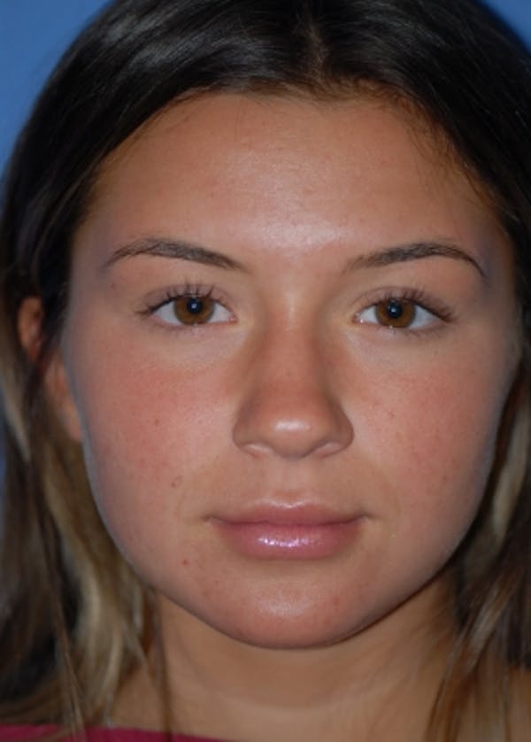 Rhinoplasty Before & After Gallery - Patient 5952183 - Image 1