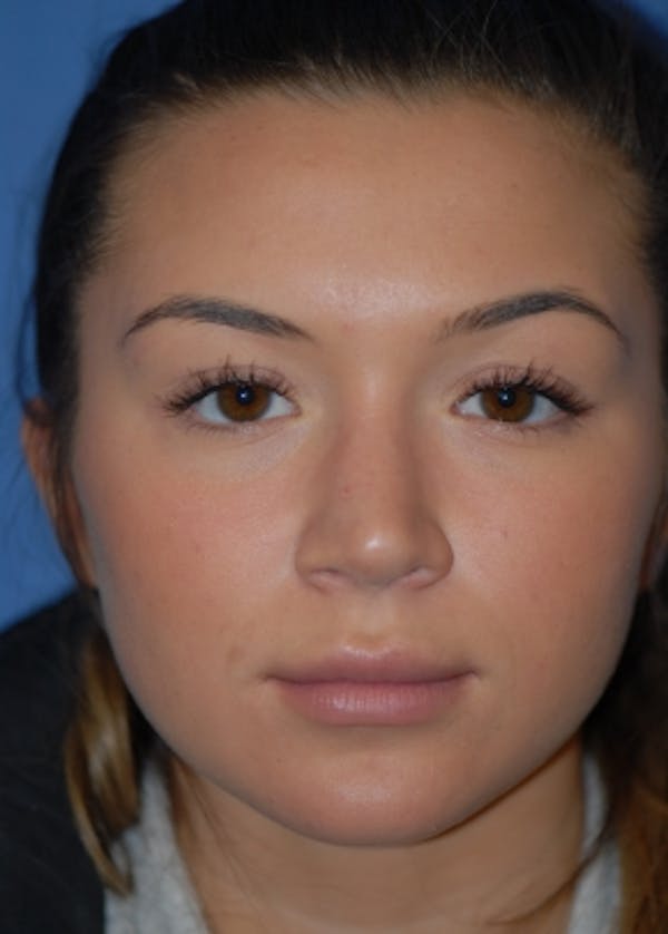 Rhinoplasty Before & After Gallery - Patient 5952183 - Image 2