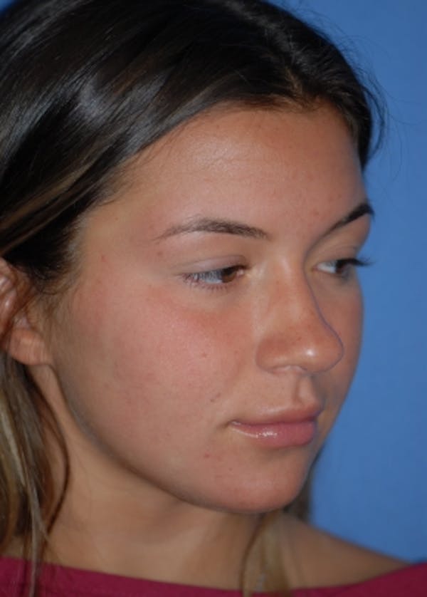 Rhinoplasty Before & After Gallery - Patient 5952183 - Image 3