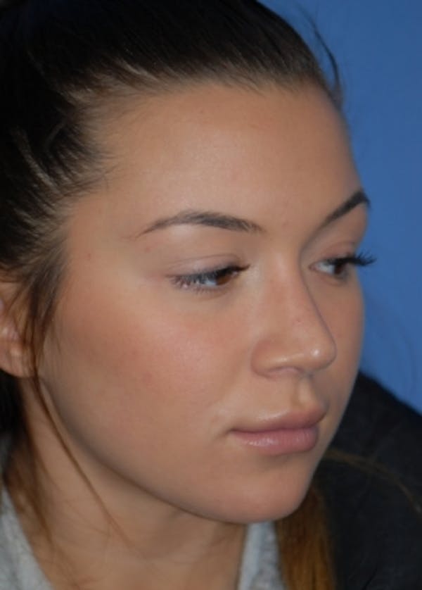Rhinoplasty Before & After Gallery - Patient 5952183 - Image 4