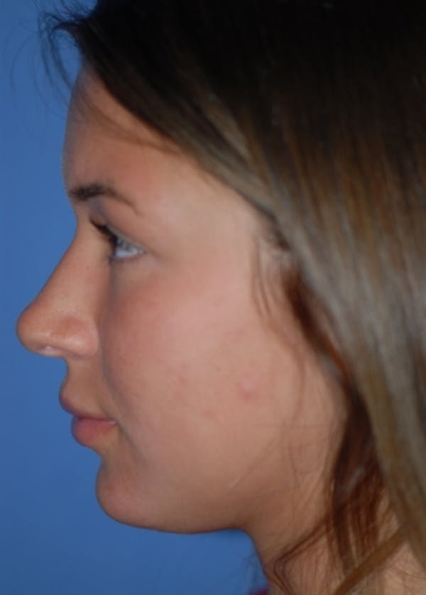 Rhinoplasty Before & After Gallery - Patient 5952183 - Image 5