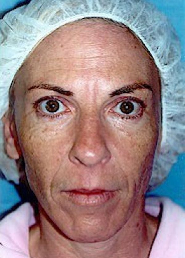 Laser Wrinkle Removal Before & After Gallery - Patient 5952182 - Image 2