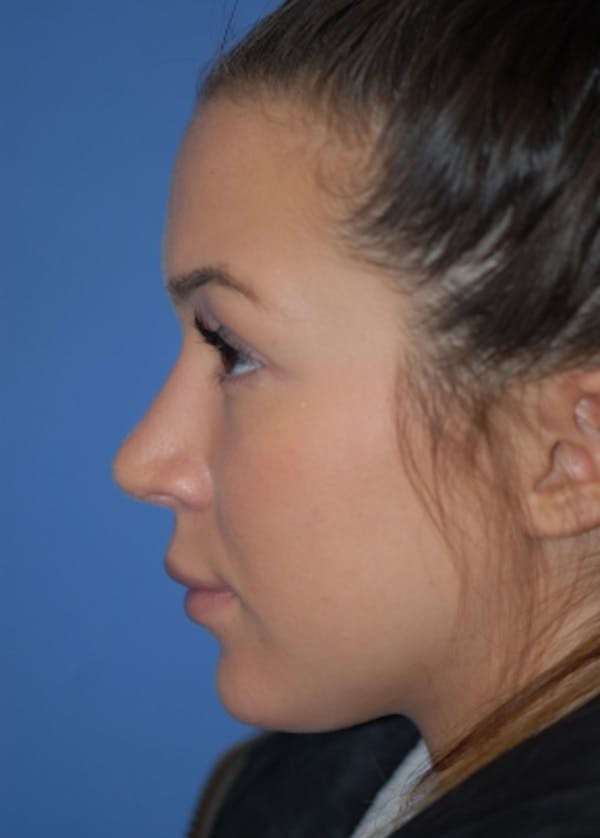 Rhinoplasty Before & After Gallery - Patient 5952183 - Image 6