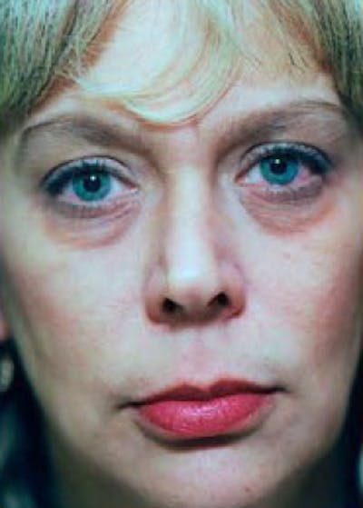 Eyelid Surgery Browlift Before & After Gallery - Patient 5952185 - Image 1