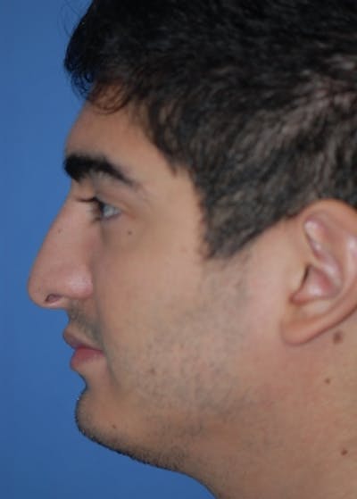 Rhinoplasty Before & After Gallery - Patient 5952187 - Image 1