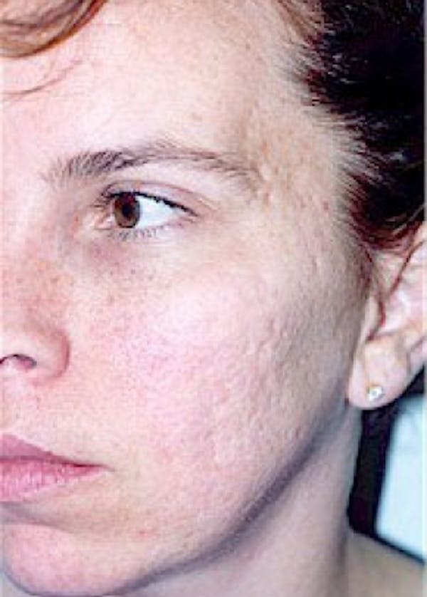 Laser Wrinkle Removal Before & After Gallery - Patient 5952190 - Image 1
