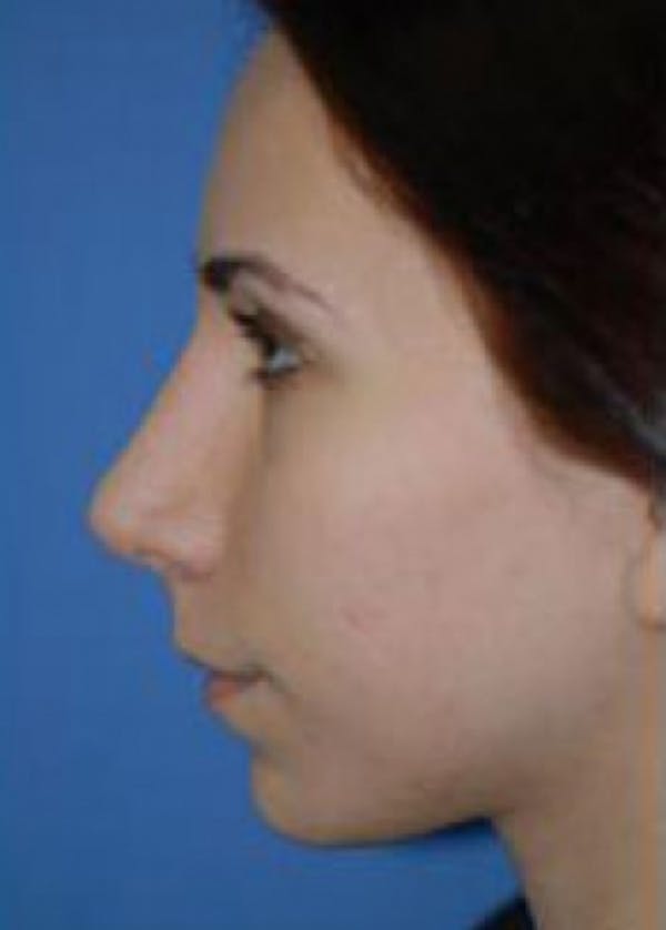 Rhinoplasty Before & After Gallery - Patient 5952191 - Image 2