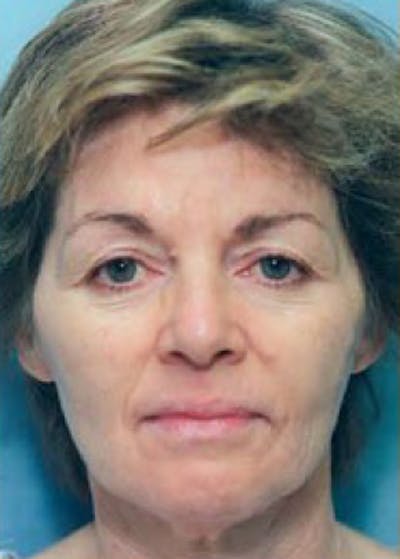 Facelift and Mini Facelift Before & After Gallery - Patient 5952200 - Image 1