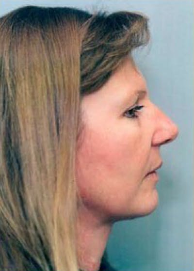 Facelift and Mini Facelift Before & After Gallery - Patient 5952212 - Image 2