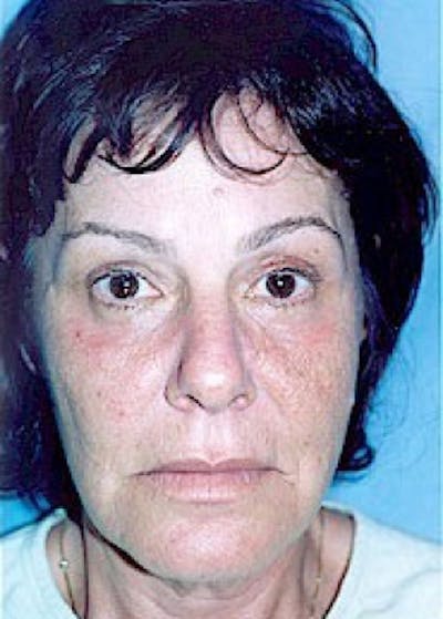 Eyelid Surgery Browlift Before & After Gallery - Patient 5952214 - Image 2