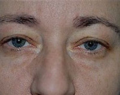 Eyelid Surgery Browlift Before & After Gallery - Patient 5952216 - Image 1