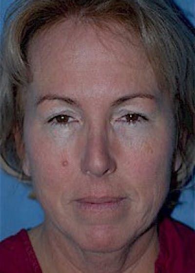 Facelift and Mini Facelift Gallery - Patient 5952224 - Image 1
