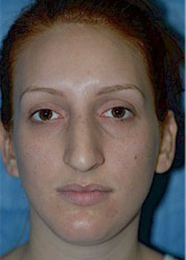 Rhinoplasty Before & After Gallery - Patient 5952225 - Image 1