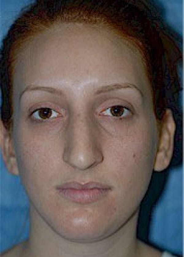 Rhinoplasty Before & After Gallery - Patient 5952225 - Image 1