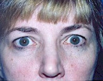 Eyelid Surgery Browlift Gallery - Patient 5952226 - Image 1