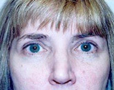 Eyelid Surgery Browlift Before & After Gallery - Patient 5952226 - Image 2