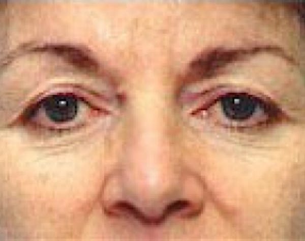 Eyelid Surgery Browlift Before & After Gallery - Patient 5952227 - Image 1