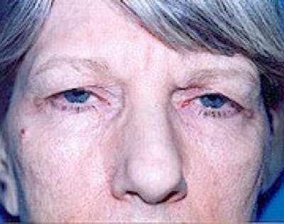 Eyelid Surgery Browlift Before & After Gallery - Patient 5952229 - Image 1