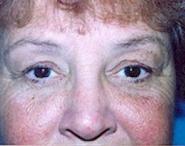 Eyelid Surgery Browlift Before & After Gallery - Patient 5952233 - Image 1