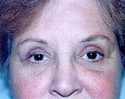 Eyelid Surgery Browlift Before & After Gallery - Patient 5952233 - Image 2
