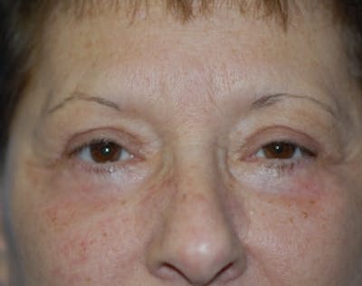 Eyelid Surgery Browlift Before & After Gallery - Patient 5952235 - Image 2