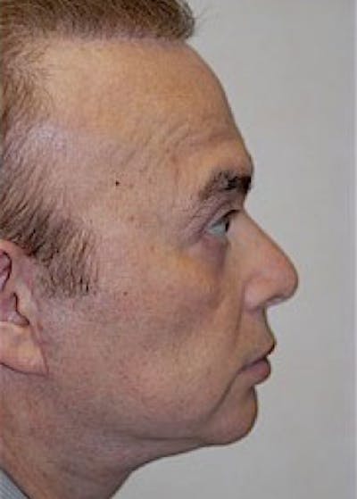 Facelift and Mini Facelift Before & After Gallery - Patient 5952241 - Image 2