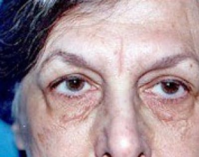 Eyelid Surgery Browlift Before & After Gallery - Patient 5952243 - Image 1