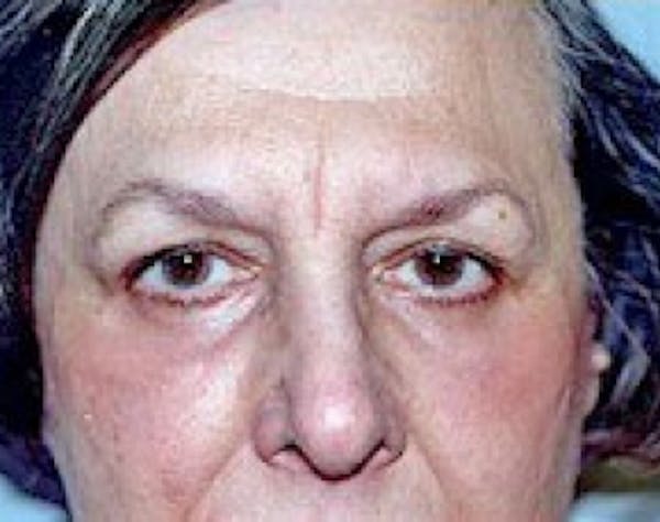 Eyelid Surgery Browlift Gallery - Patient 5952243 - Image 2