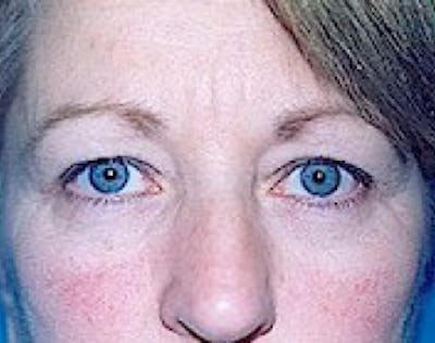 Eyelid Surgery Browlift Before & After Gallery - Patient 5952251 - Image 1