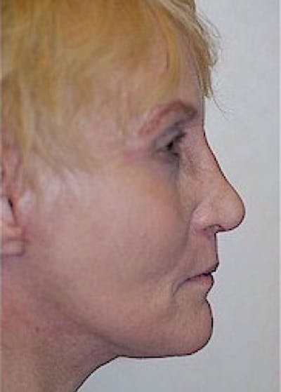 Facelift and Mini Facelift Before & After Gallery - Patient 5952249 - Image 4
