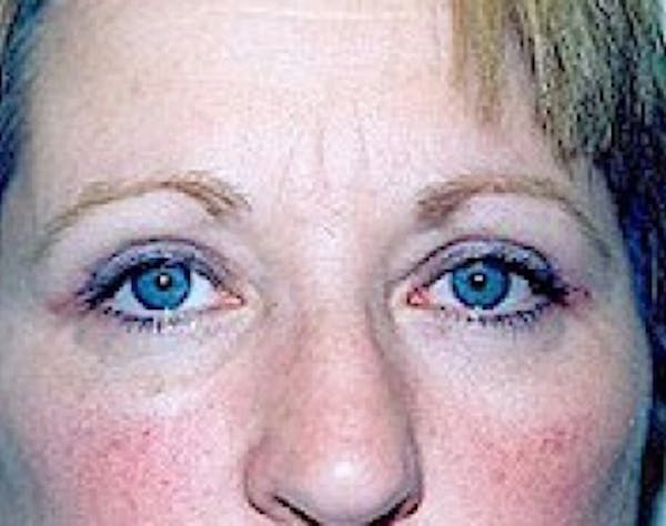 Eyelid Surgery Browlift Gallery - Patient 5952251 - Image 2
