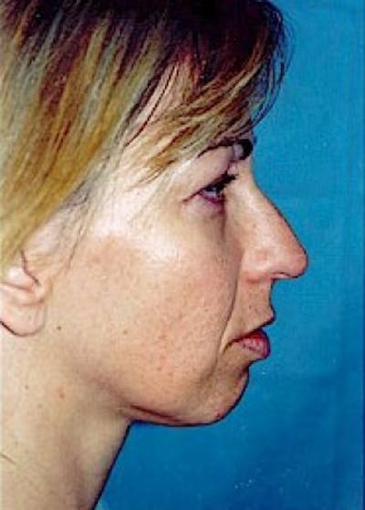Rhinoplasty Before & After Gallery - Patient 5952260 - Image 1