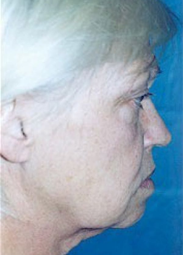 Facelift and Mini Facelift Before & After Gallery - Patient 5952261 - Image 1