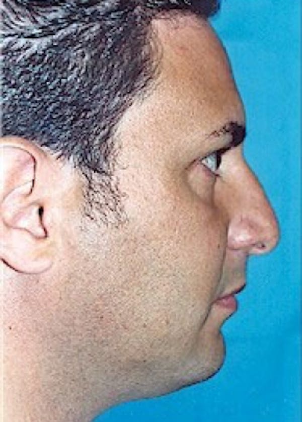 Rhinoplasty Before & After Gallery - Patient 5952262 - Image 1