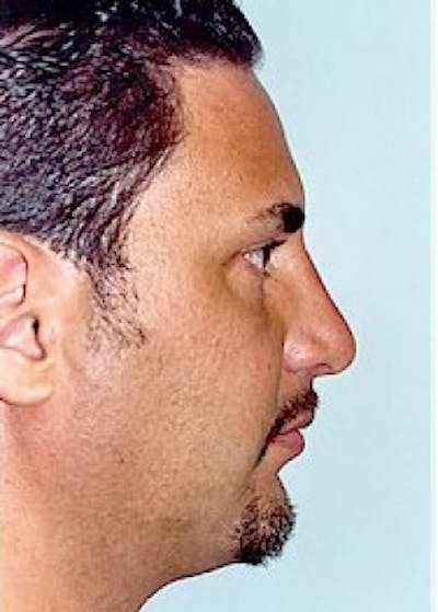 Rhinoplasty Before & After Gallery - Patient 5952262 - Image 2