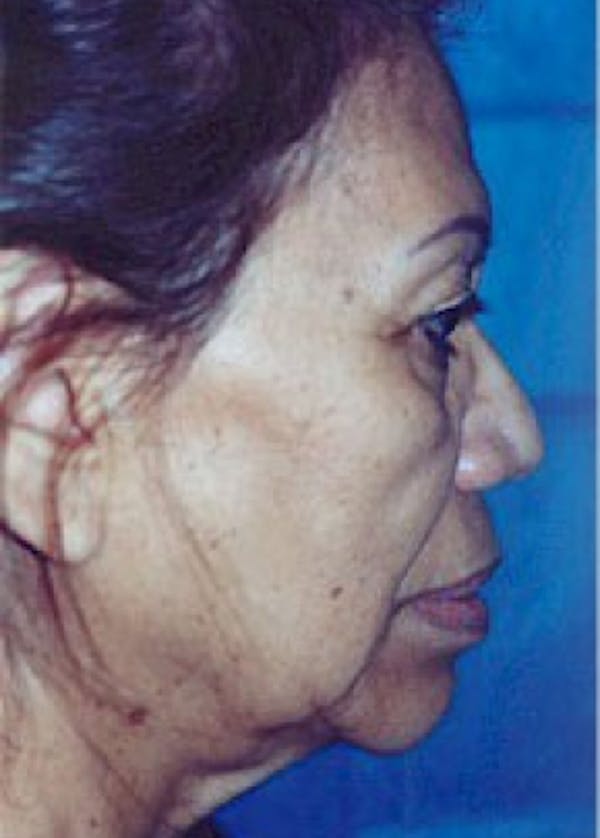 Facelift and Mini Facelift Gallery - Patient 5952270 - Image 1