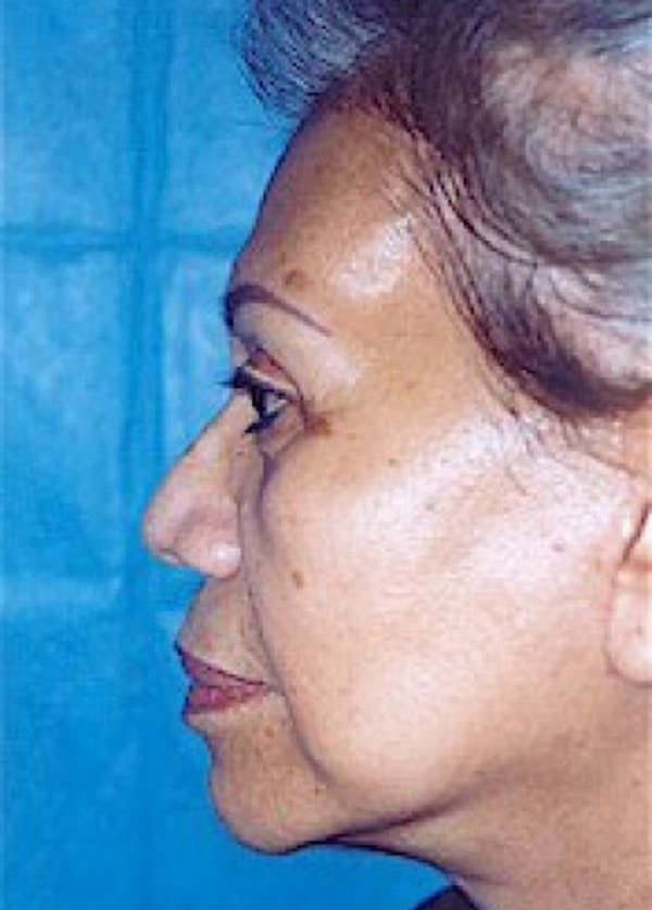 Facelift and Mini Facelift Before & After Gallery - Patient 5952270 - Image 4