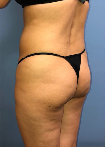 Brazilian Butt Lift Before & After Gallery - Patient 11203283 - Image 1