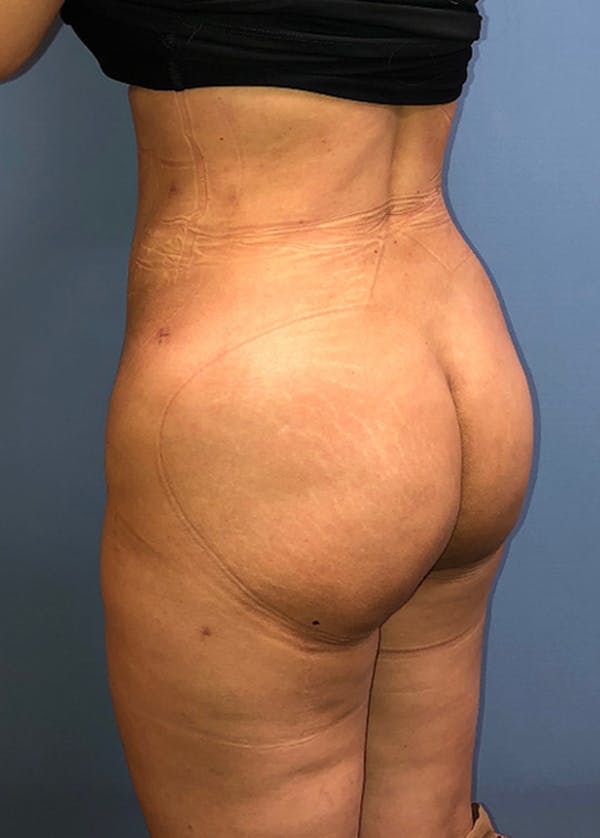 Brazilian Butt Lift Before & After Gallery - Patient 11203283 - Image 2