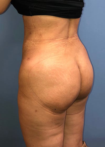 Brazilian Butt Lift Gallery - Patient 11203283 - Image 2