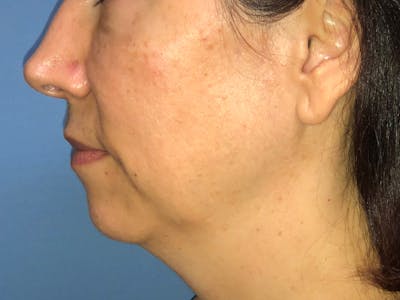 Necklift & Necklipo Before & After Gallery - Patient 154108593 - Image 1