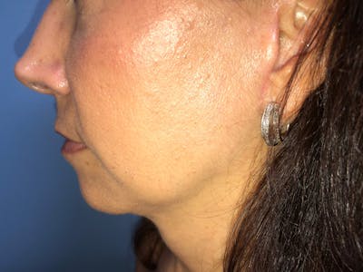 Necklift & Necklipo Before & After Gallery - Patient 154108593 - Image 2